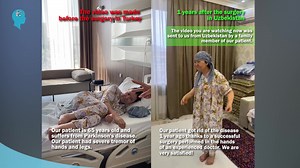 📍 Deep Brain Stimulation in Turkey 🔹 Our patient came to our center from Uzbekistan 1 year ago. 🔹 Our patient is 65 years old and suffers from Parkinson's disease. Our patient had severe tremor of hands and legs. 🔹 Our patient needed someone's help all the time. She could not stand up on her own. 🔹 In addition, our patient had difficulty even taking a step without assistance. She could not walk.... 🔹 Prior to Deep Brain Stimulation (DBS) surgery, our patient was bedridden. 🔹 She could not