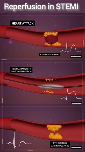 Abdallah Othman on Instagram: "STEMI: From Occlusion to Reperfusion & Outcomes Event: Coronary plaque rupture → thrombosis → vessel occlusion → transmural ischemia (ST-elevation). Treatment: Immediate primary PCI (angioplasty) to restore flow. Post-PCI Spectrum: 1. Optimal: TIMI 3 flow, ECG normalization. 2. Stunned Myocardium: Patent artery with persistent T-wave inversion. 3. Residual Disease: Critical residual stenosis (e.g., 99%) causing angina at rest. 4. Managed Stenosis: Significant resid