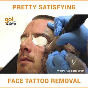 85K views · 141 reactions | This face tattoo removal is pretty...