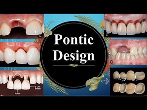 Everything about Pontic Design of Bridges