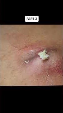 #blackheads Removal #pimplepopping #asmr #satisfying #13 part 2