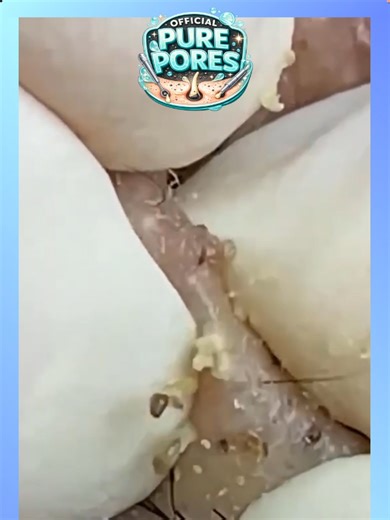 MEGA COMPILATION #11 - Official Pure Pores Skin Care React to Soothing facial treatments ASMR @officialpurepores #blackheadremoval #pimplepopping #acneextraction Voice reaction and animations to Extreme blackhead removal, deep pore cleansing, intense acne extraction and satisfying skincare close-ups captured in HD and 4K macro detail. This video features real pimple popping, whitehead extraction, nose pore cleaning and deep skin cleansing designed to be relaxing and oddly satisfying. Watch clogg