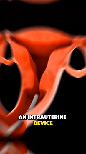 441K views · 3.5K reactions | What is an IUD and how does it work? Benefits and side effects explained#familyplanning #mom #momlife #momtips #mommies #health | Community Nurse | Facebook