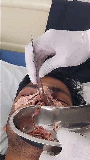 Nasal Packing Removal - 3rd day after surgery