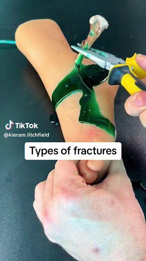First Aid: Types of Fractures & How to Splint a Broken Bone