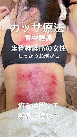 【坐骨神経痛の女性】をカッサ療法