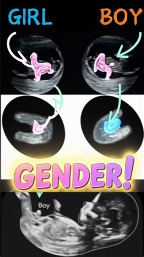 Boy or Girl? Real Ultrasound Gender Reveal Explained! 👶 #medical #pregnancy #gynaecology #shorts