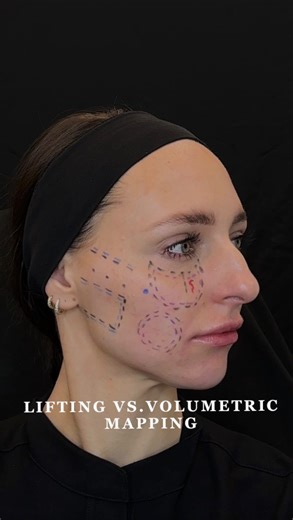 Riley Worth Henrichsen APRN, MSN, FNP-C, FNP-BC on Instagram: "Remember that your artistry is within the patient assessment! Lifting codes: CK1, CK2, CK4 Volumetric codes: CK3 and CK5 Which do you inject the most in your practice ?!? #mdcodes #growth #juvederm #injectables #botox"