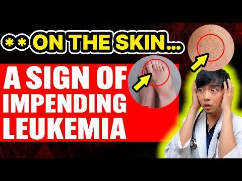 5 Warning Signs You Might Be One Step Away from Leukemia – Doctor Explains