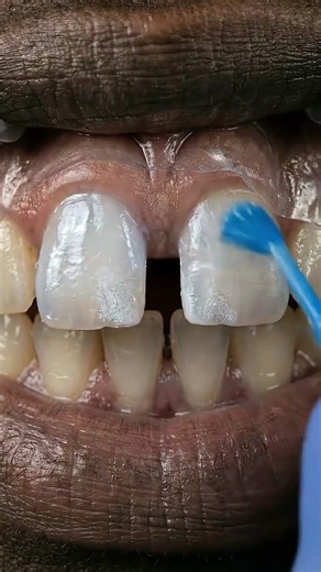 Gap Between His Front Teeth DISAPPEARED Instantly