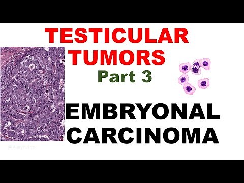 EMBRYONAL CARCINOMA- Etiopathogenesis , Clinical features , Morphology & Treatment