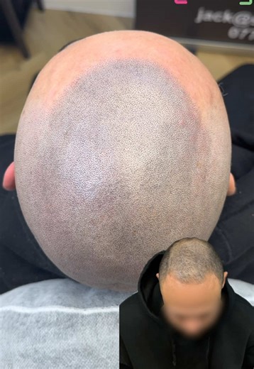 2 sessions down on this one 🙌🏻 the clients unsure whether he is going to go for the shaven look or grow it out slightly as he does have good coverage on top so we worked within the existing hair and over the next few weeks between his second and third session he is going to see how he feels with it shaved and make the final decision 👊🏻 if he likes it shaven down we will lower the hairline if not it will just be finishing touches 👌🏻around 15 hours of needling on just two sessions here 💉 . 