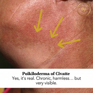 It's not a sunburn. It's not a rash. And no, it's not because you forgot moisturiser. Meet Poikiloderma of Civatte, the chronic, harmless but oh-so-annoying condition that loves your neck, chest, and cheeks. It looks like reddish-brown patches with tiny visible vessels, skin thinning… and the ultimate plot twist? It skips the shaded chin (often leaving a white triangle under the chin). Caused mainly by long-term UV exposure (thanks, sun), it can be worsened by hormones or even perfume. It shows 