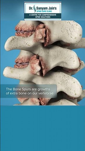What Are Spinal Bone Spurs? Explained by Dr. Sanyam Jain | Best Spine Surgeon in Delhi NCR
