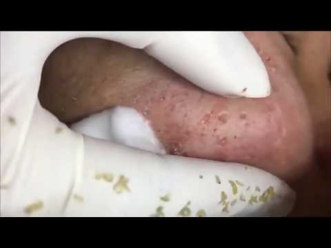 Pimple, Popping, Removing Blackheads around eyes and mouth, Bigger Blackhead , on the face, acne140
