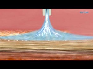 The Principle of the Argon Plasma Coagulation by Yare Healthcare Private Limited, Delhi