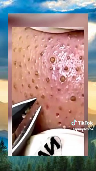 pimple popping satisfying foryou squeeze abscess skincare viral removal acne (272)