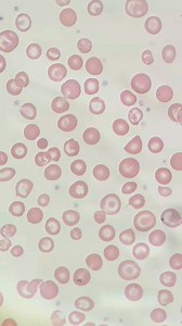 Blood smear ❤️🔬😲 #hematology #microscope #lablife | Lab life