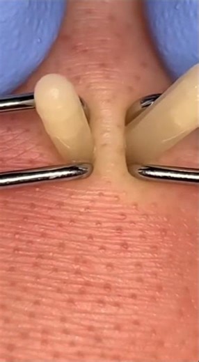 Double Sebum Thread Extraction | Perfect Synchronized Pull #satisfying #extraction