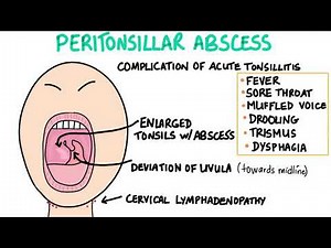 PERITONSILLAR ABSCESS- cause, presentation, diagnosis, treatment