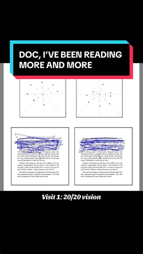 Look at this. This is the VR eye tracking with the prism lenses I prescribed. Over 4 visits in 7 months, you can literally see the change: \t•\tHer tracking is smoother and actually staying on the lines \t•\tThe lines are more lined up and stable \t•\tShe read for longer in the same amount of time And here’s the crazy part: we did zero vision therapy. On top of that, she started going to more school, got a job, and started working more. Still, her reading improved. Vivid Visions Optometry, Inc. 