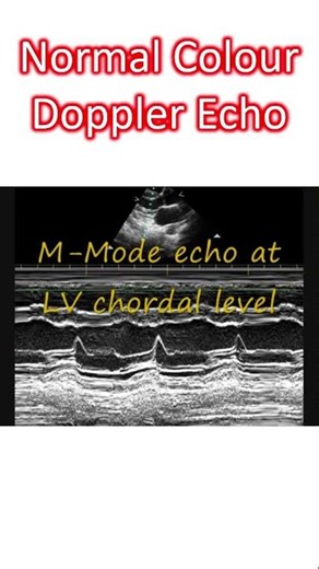 Normal Colour Doppler Echocardiogram