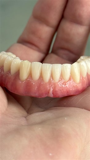 Juan Francisco Chaves Rodríguez | Sobredentadura sobre Locator caracterizada con composite #nexco. Pulido mecánico por si preguntáis…no hay barnices. . . . . . . . . . . . .... | Instagram