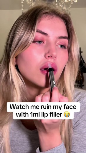Lip Filler Experience: Before and After Transformation