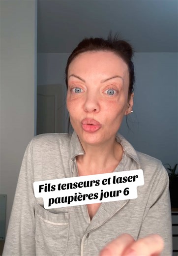 Fils Tenseurs et Laser Paupières : Jour 6