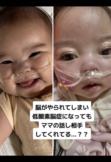 低酸素脳症の千香ちゃんとの心温まる日々