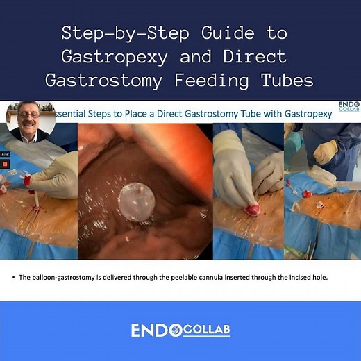 Step-by-Step Guide to Gastropexy and Direct Gastrostomy Feeding Tubes