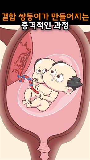생존을 위한 배아들의 눈물겨운 선택, 그 대가는?#결합쌍둥이 #샴쌍둥이