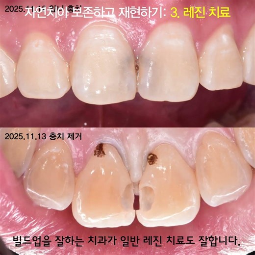 자연치아를 보존하고 복원합니다: 미니쉬, 레진빌드업, 레진치료, MTA 치수복조