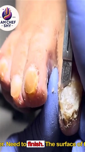 21K views · 87 reactions | Simple Tips to Prevent Ingrown Toenails #HealthyHabits #SafeSteps #SeniorHealth | I am Chef Shy | Facebook