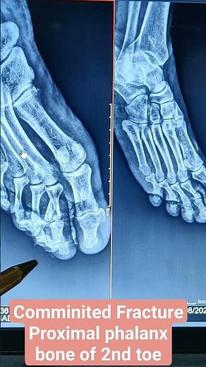 Communited Fracture Proximal Phalanx bone of 2nd toe #scdhomecare #xrayathome #sheetalchhaya #viral