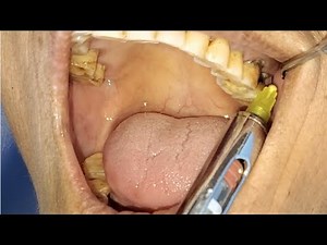 Upper molar tooth extraction