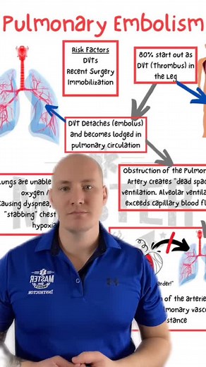 Pathophysiology of Pulmonary Embolisms Part 1 #paramedicstudent #paramedicschool #emt #emtschool #emtstudent