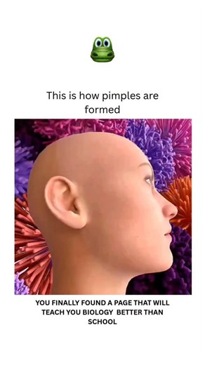 BIOLOGY | MEDICAL | HEALTH on Instagram: "Pimples form when hair follicles, or pores, become clogged with excess oil (sebum) and dead skin cells, leading to inflammation and bacterial growth. Hormonal changes, especially during puberty, increase sebum production, creating an environment where bacteria like Propionibacterium acnes (or C. acnes) can thrive and multiply. This infection triggers the body’s immune response, causing the hair follicle to swell and redden, resulting in a pimple. The Pro