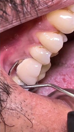 💥 Bad Breath? Your old Dental Crown is the Cause! 😬 Fix It Now! 💥