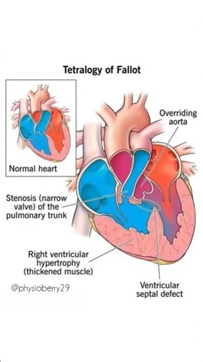 Tetralogy of fallot 🫀cardiac defects #tetralogyoffallot #congenitalheartdisease @PhysioBerry29