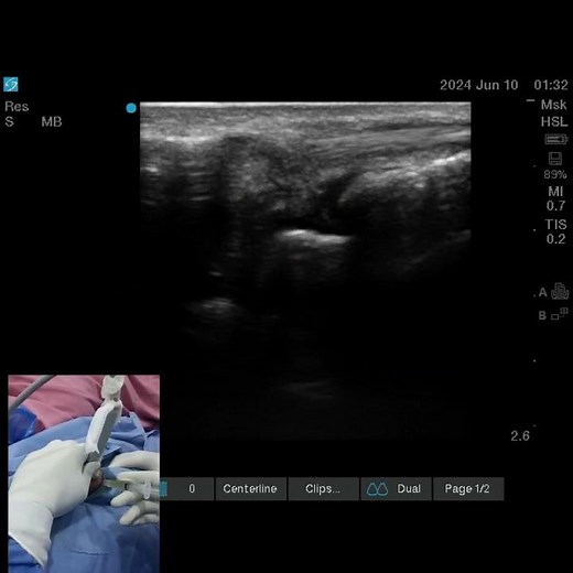 TFCC Injection #wristpain #painmanagement #nonsurgical #ultrasound #prp