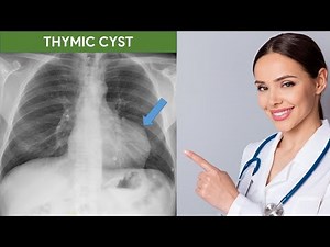 Thymic Cyst in Chest X ray & CT Scan
