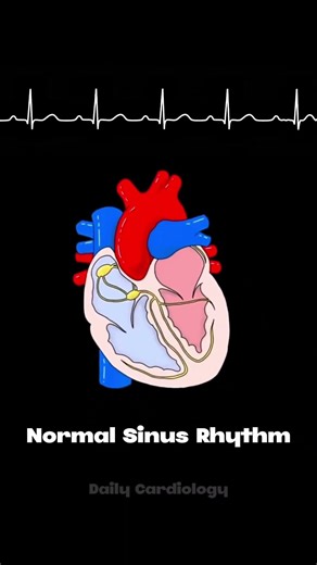 Normal sinus rhythm vs Atrial Fibrillation vs Atrial Flutter #ecg #arrhythmia #cardiology #afib