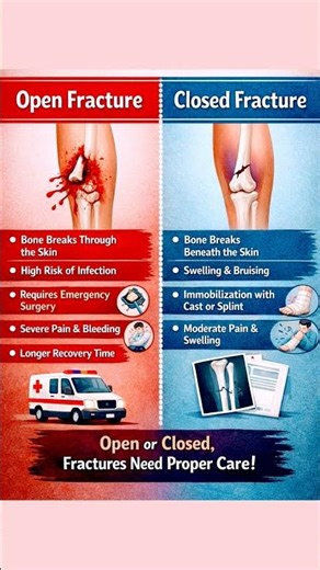Open v/s Closed Fracture #viral #biology #medicalcoding #sehat #cpc #icd10cm #anatomy