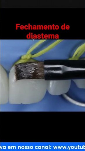 Tips for closing a diastema