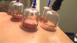 Close Up: Man Receives Chinese Cupping Stock Footage SBV-324627678 - Storyblocks
