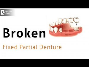 How to manage FPD breakage after traumatic dental injury? - Dr. Pujari M R