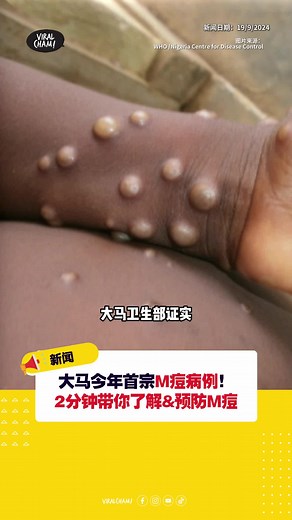 大马首宗M痘病例与预防措施介绍