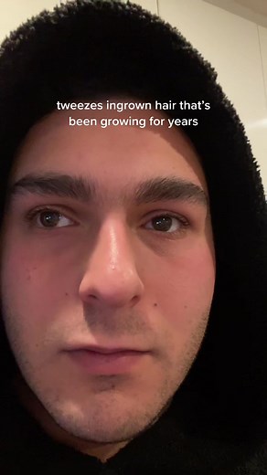 Ingrown Hair Removals: Expert Techniques by Dr. Sandra Lee