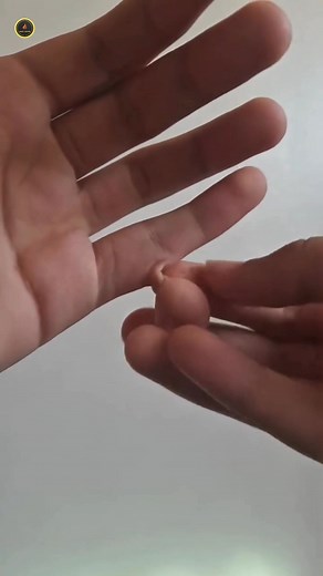 Rudimentary postaxial polydactyly #viralfact #science #facts #reel #medicaleducation #polydactyly | Crazy factor